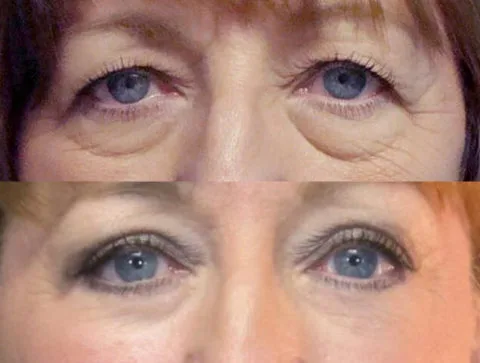 Before / After — 5