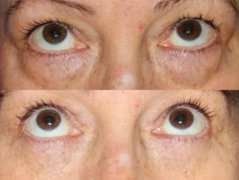 Before / After — 6